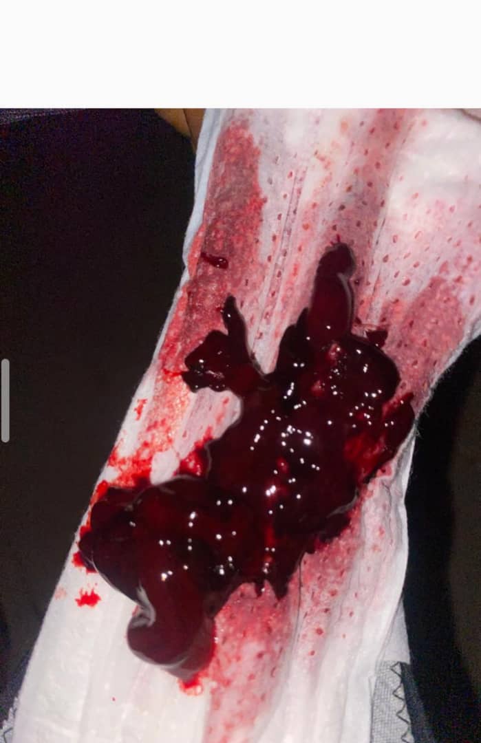 IRREGULAR MENSTRUATION